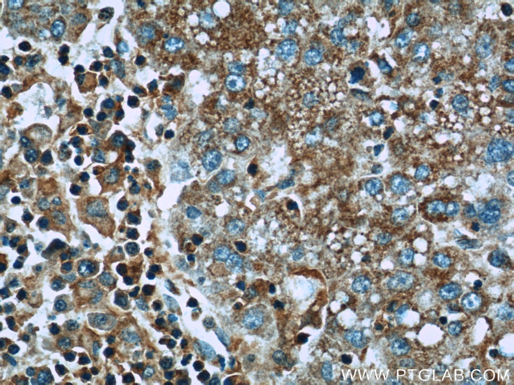 Immunohistochemistry (IHC) staining of human liver cancer tissue using IGF2R-Specific Polyclonal antibody (20253-1-AP)