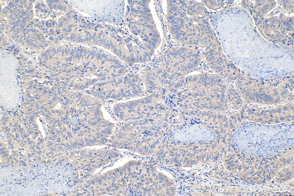 Immunohistochemistry (IHC) staining of human lung cancer tissue using IGFBP1 Polyclonal antibody (13981-1-AP)