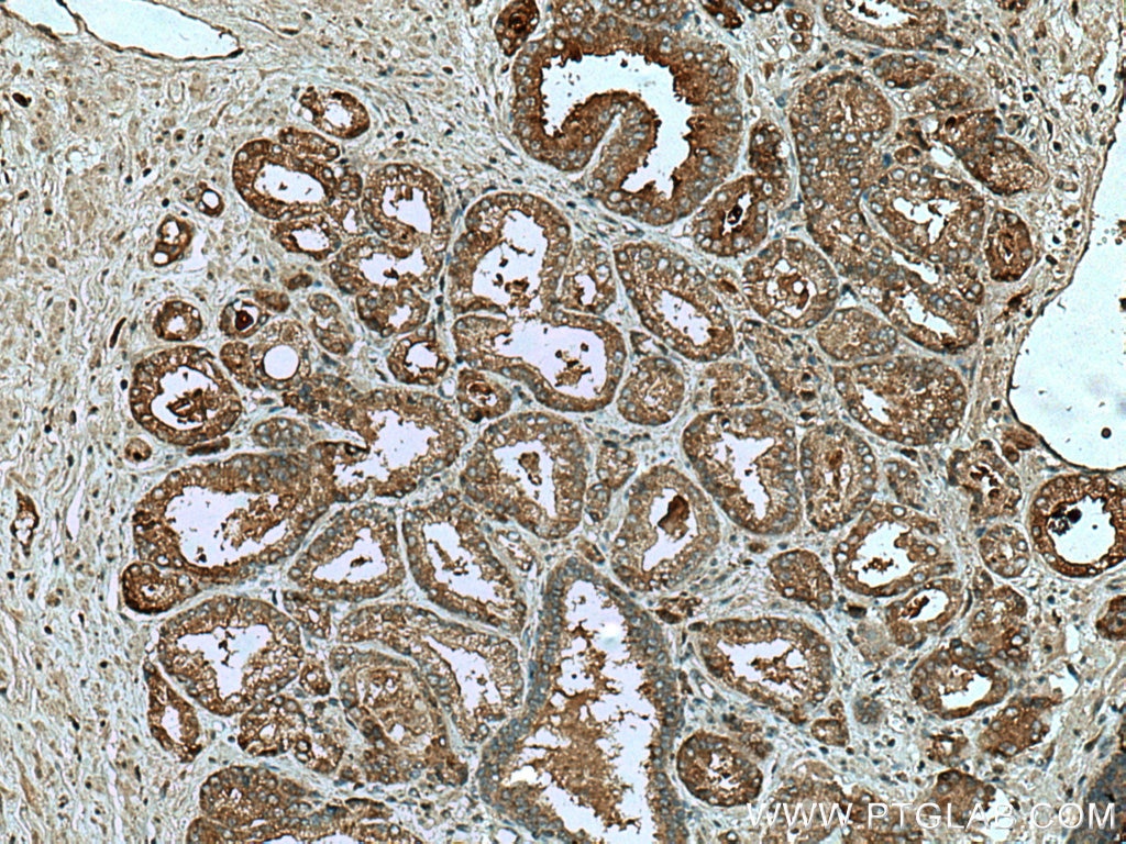 Immunohistochemistry (IHC) staining of human prostate cancer tissue using IGFBP2 Polyclonal antibody (11065-3-AP)