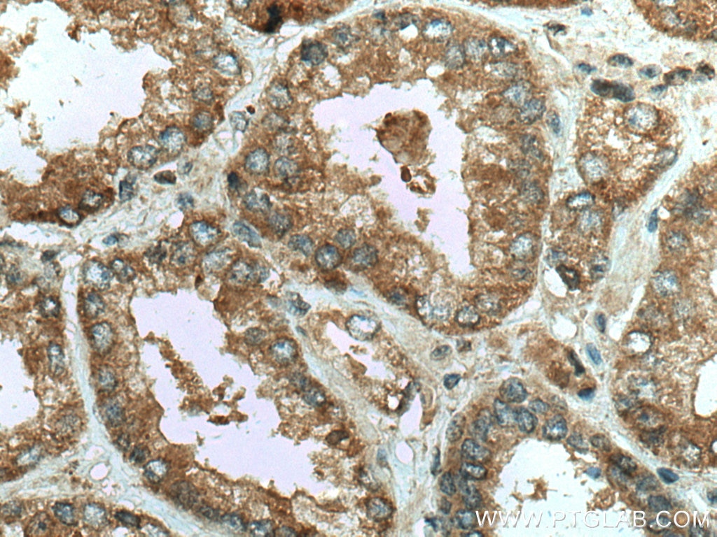 Immunohistochemistry (IHC) staining of human prostate cancer tissue using IGFBP2 Polyclonal antibody (11065-3-AP)