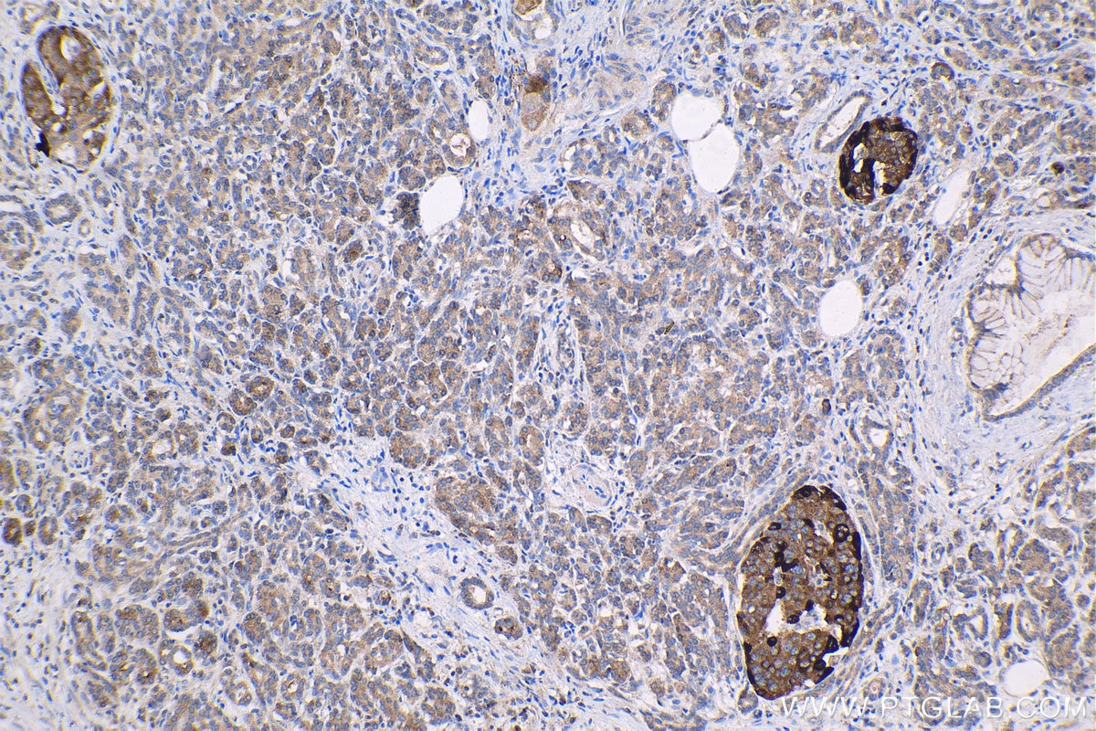 Immunohistochemistry (IHC) staining of human pancreas cancer tissue using IGFBP2 Polyclonal antibody (11065-3-AP)