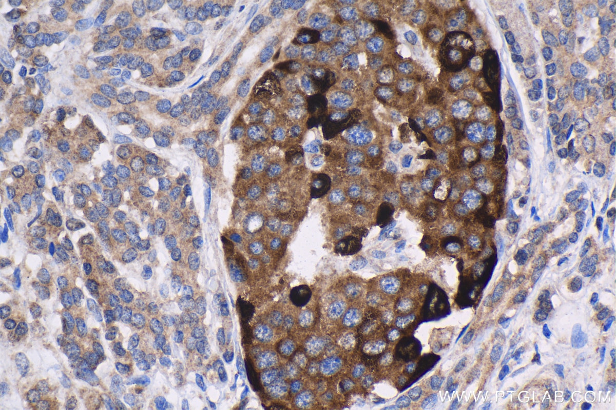Immunohistochemistry (IHC) staining of human pancreas cancer tissue using IGFBP2 Polyclonal antibody (11065-3-AP)