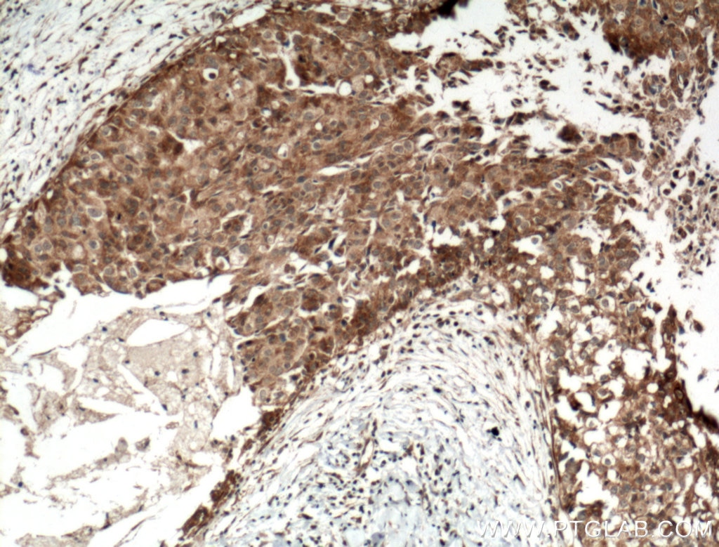 Immunohistochemistry (IHC) staining of human breast cancer tissue using IGFBP2 Polyclonal antibody (15699-1-AP)