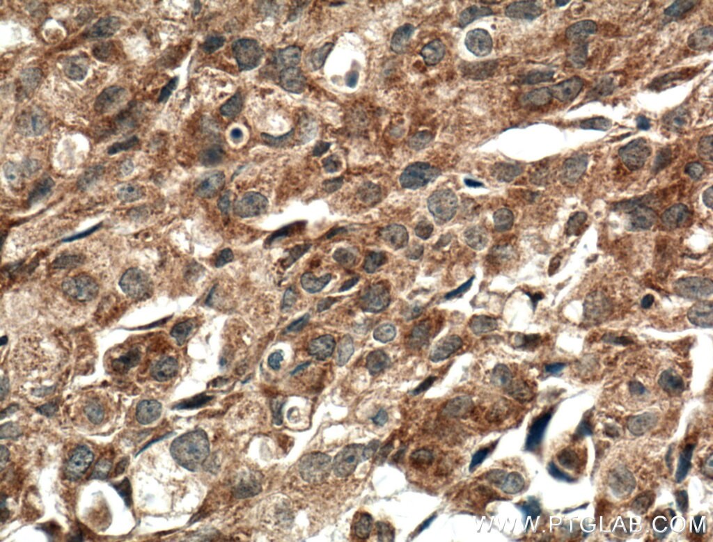 Immunohistochemistry (IHC) staining of human breast cancer tissue using IGFBP2 Polyclonal antibody (15699-1-AP)