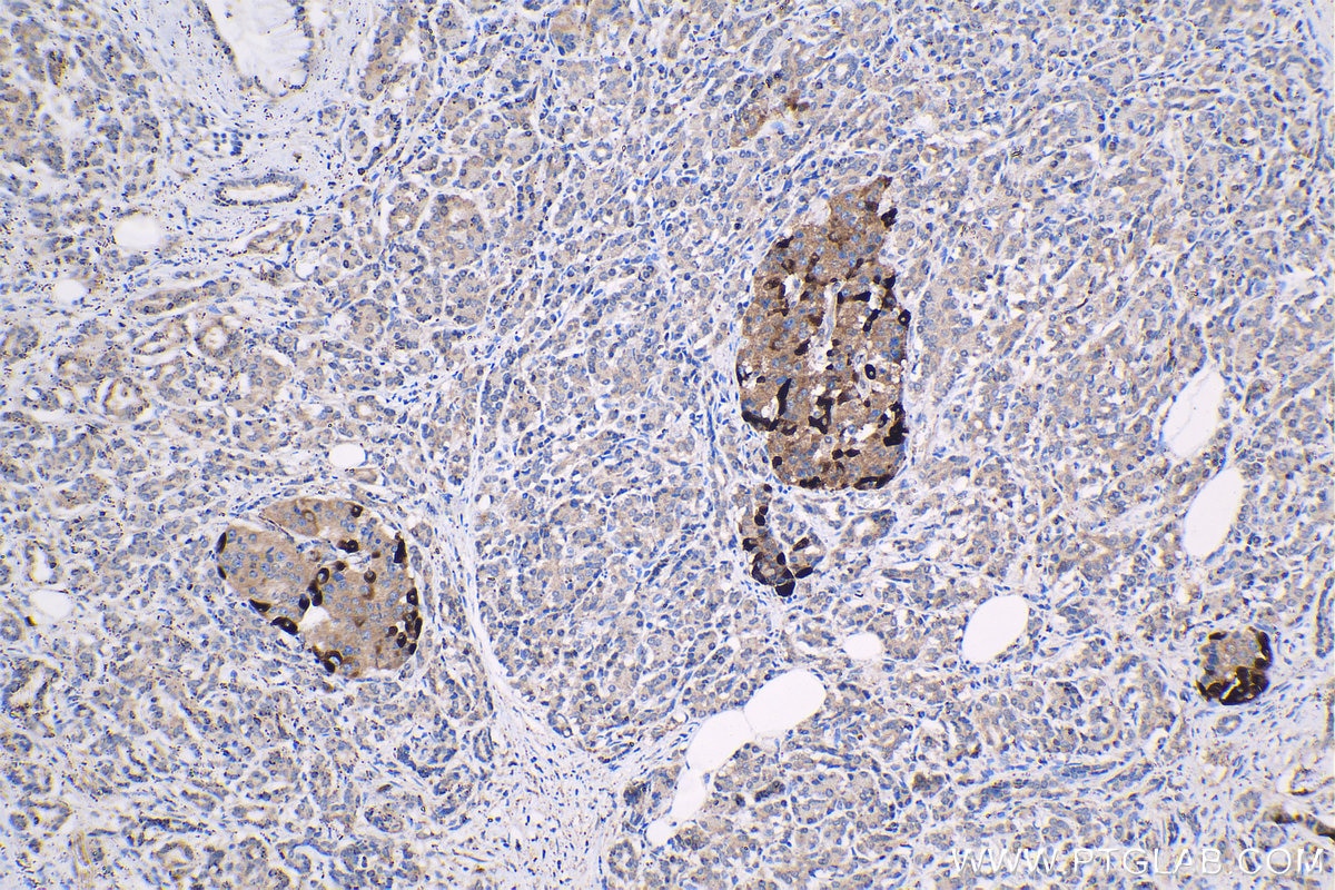 Immunohistochemistry (IHC) staining of human pancreas cancer tissue using IGFBP2 Polyclonal antibody (15699-1-AP)