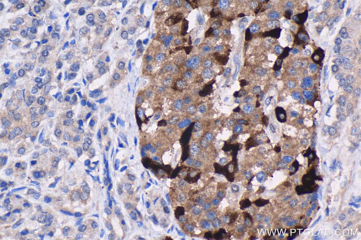 Immunohistochemistry (IHC) staining of human pancreas cancer tissue using IGFBP2 Polyclonal antibody (15699-1-AP)
