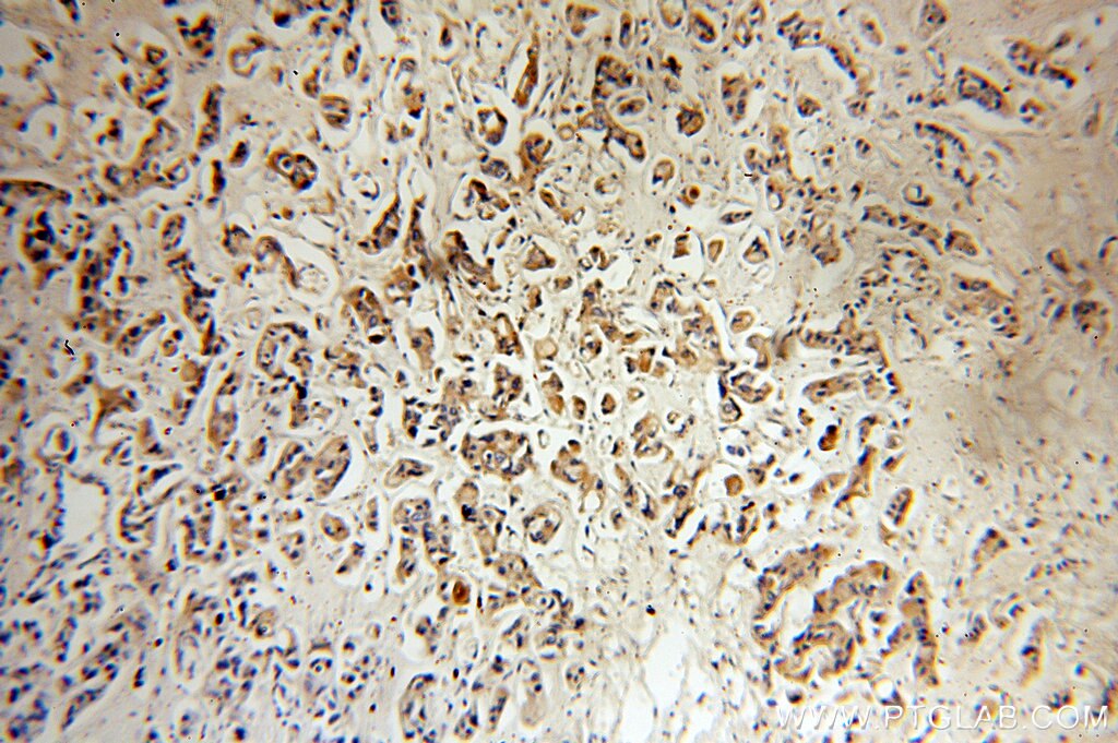 Immunohistochemistry (IHC) staining of human breast cancer tissue using IGFBP2 Polyclonal antibody (15699-1-AP)