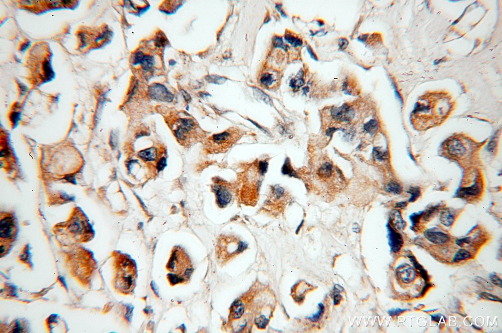 Immunohistochemistry (IHC) staining of human breast cancer tissue using IGFBP2 Polyclonal antibody (15699-1-AP)