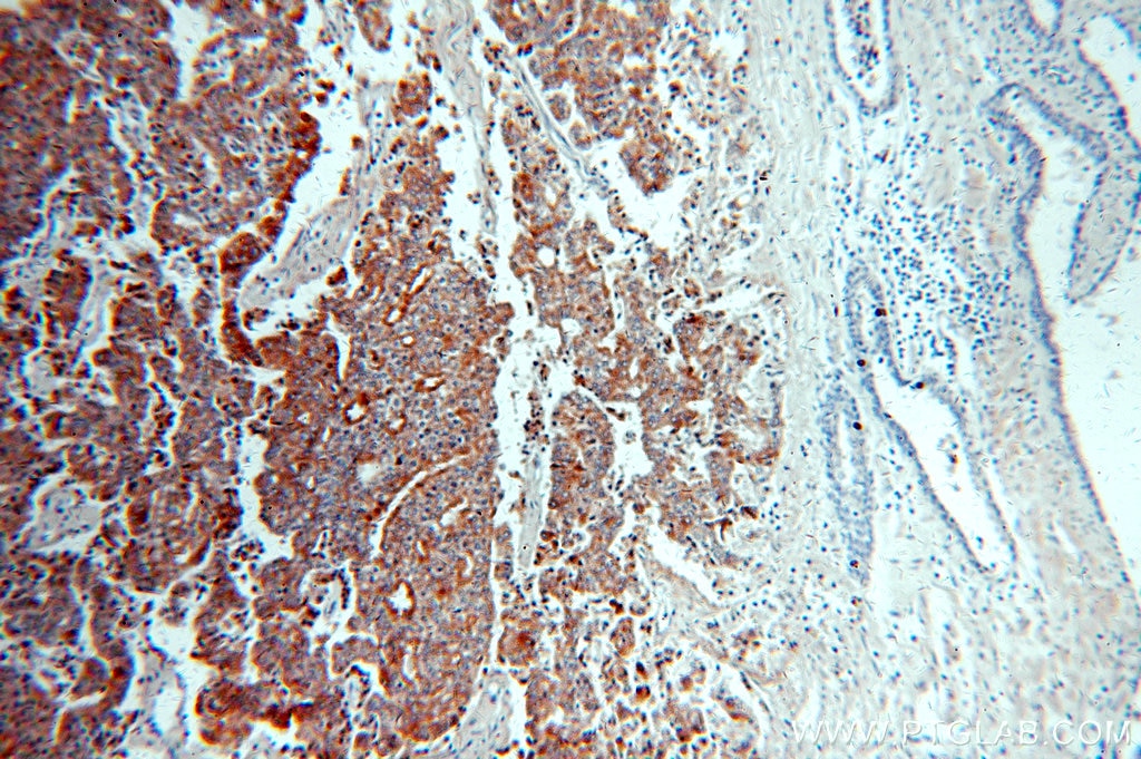 Immunohistochemistry (IHC) staining of human prostate cancer tissue using IGFBP2 Polyclonal antibody (15699-1-AP)