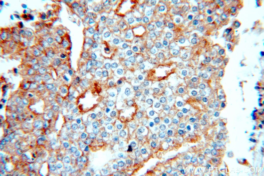 Immunohistochemistry (IHC) staining of human prostate cancer tissue using IGFBP2 Polyclonal antibody (15699-1-AP)