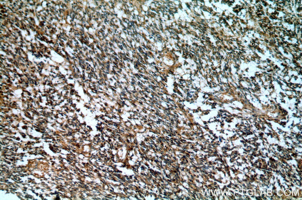 Immunohistochemistry (IHC) staining of human gliomas tissue using IGFBP2 Polyclonal antibody (15699-1-AP)