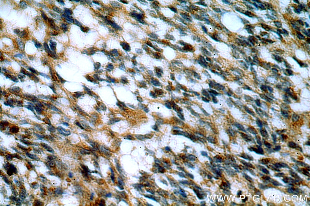 IHC staining of human gliomas using 15699-1-AP