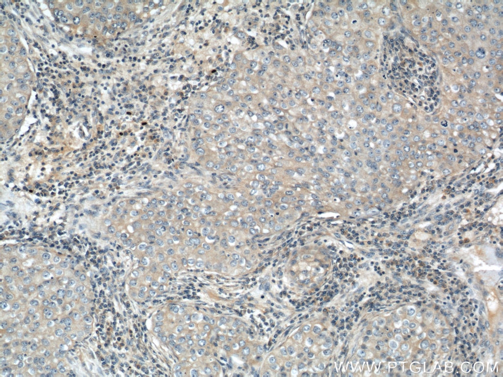 Immunohistochemistry (IHC) staining of human breast cancer tissue using IGFBP3 Polyclonal antibody (10189-2-AP)