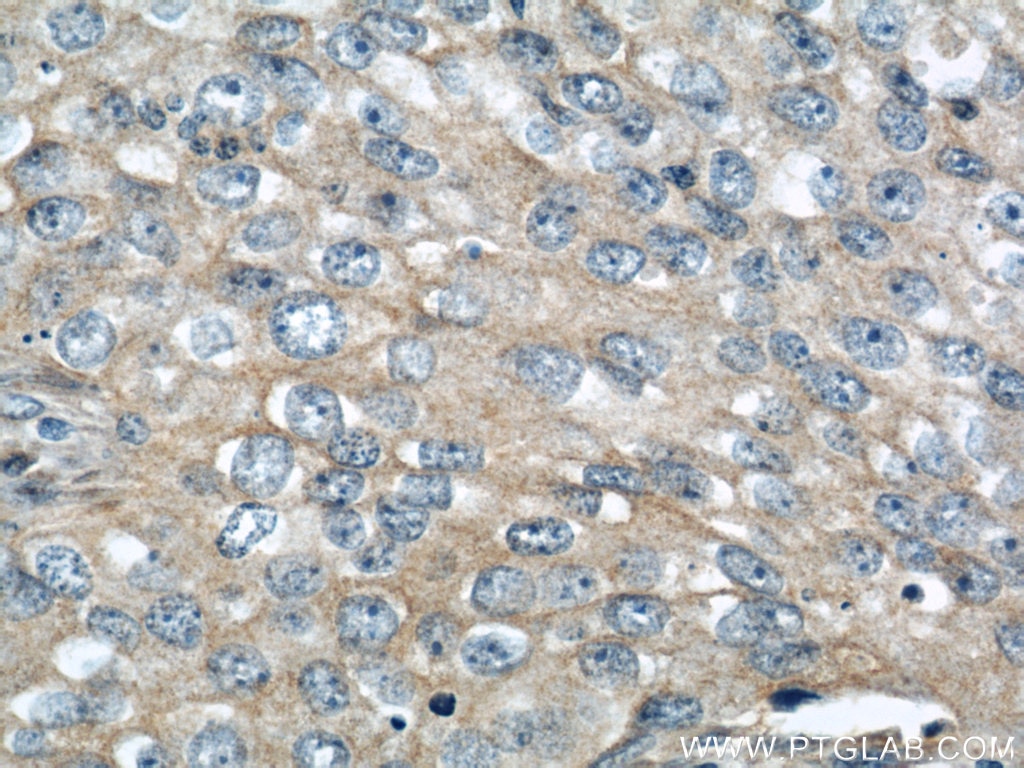 Immunohistochemistry (IHC) staining of human breast cancer tissue using IGFBP3 Polyclonal antibody (10189-2-AP)