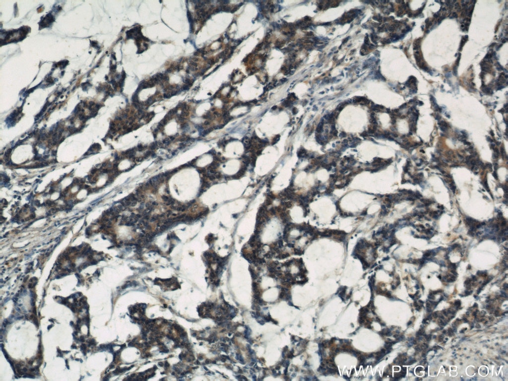 IHC staining of human colon cancer using 10189-2-AP