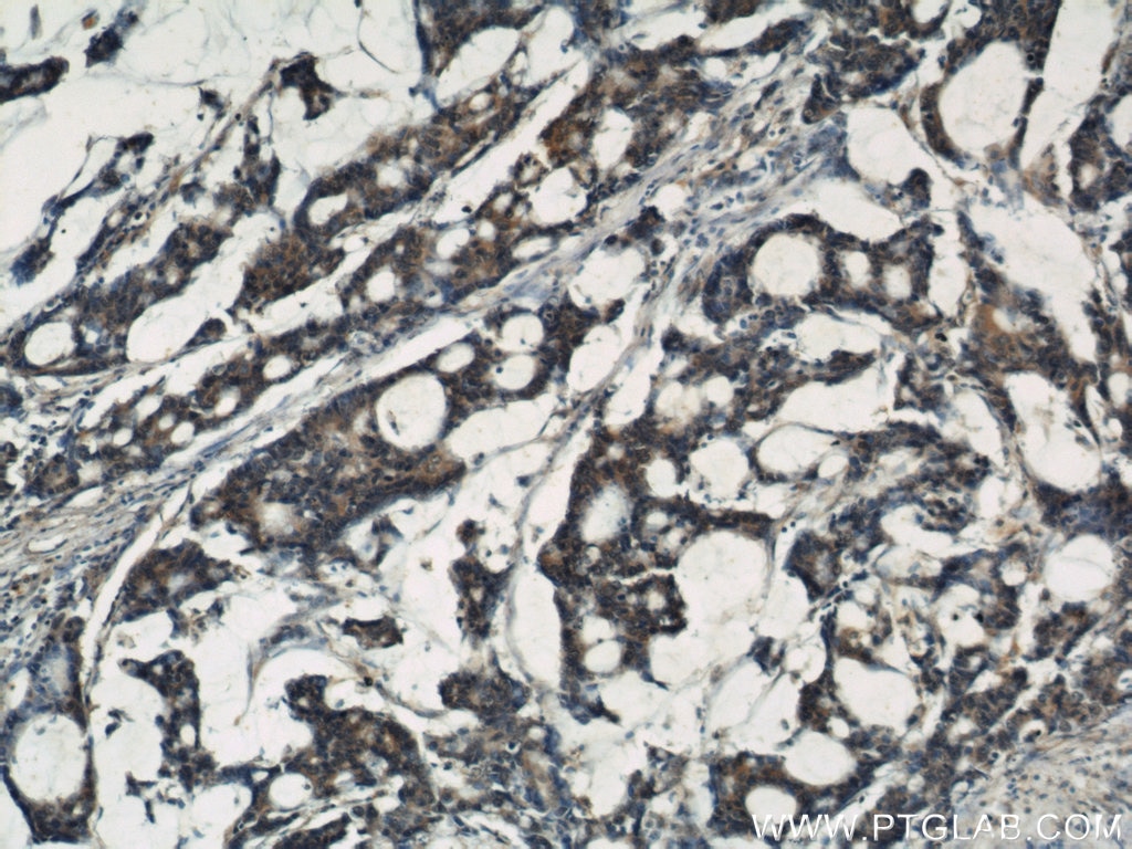 Immunohistochemistry (IHC) staining of human colon cancer tissue using IGFBP3 Polyclonal antibody (10189-2-AP)