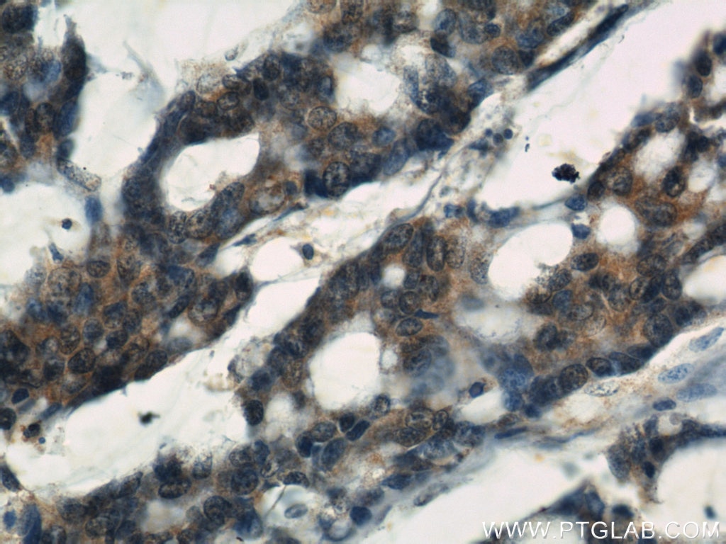 Immunohistochemistry (IHC) staining of human colon cancer tissue using IGFBP3 Polyclonal antibody (10189-2-AP)