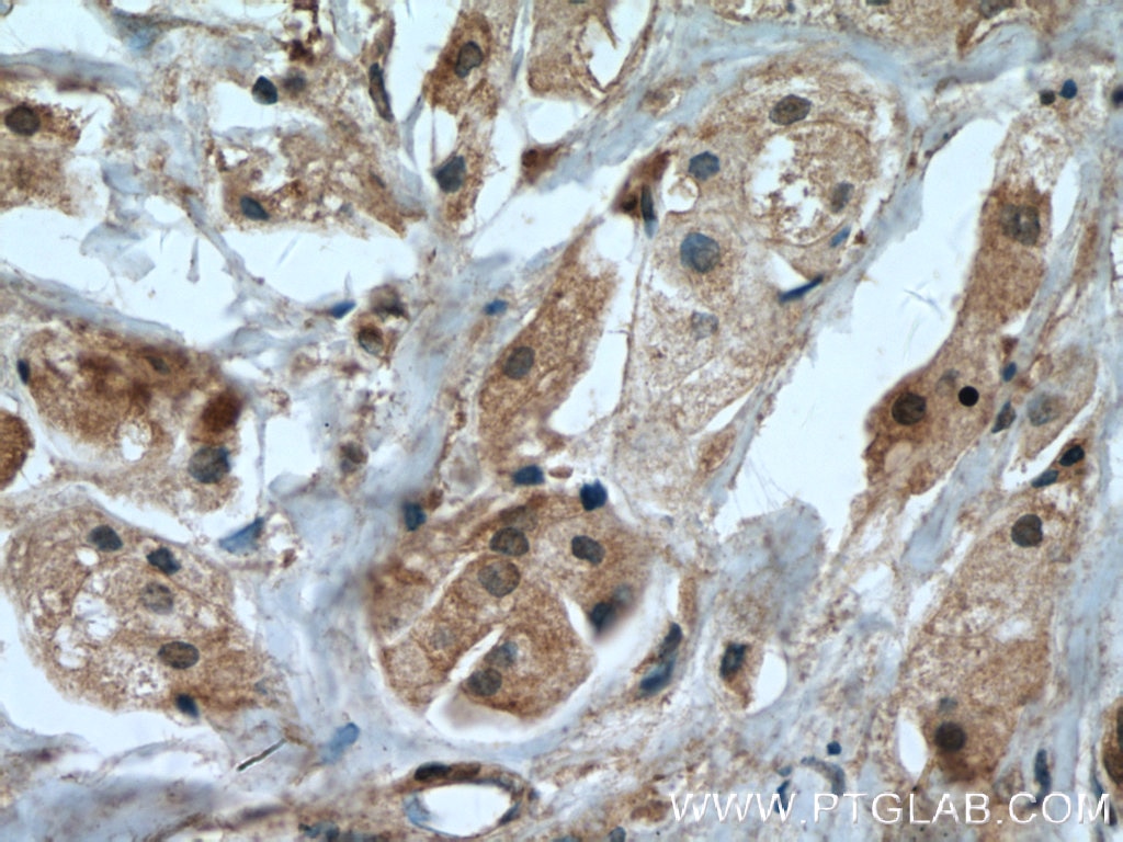 Immunohistochemistry (IHC) staining of human breast cancer tissue using IGFBP5 Polyclonal antibody (55205-1-AP)