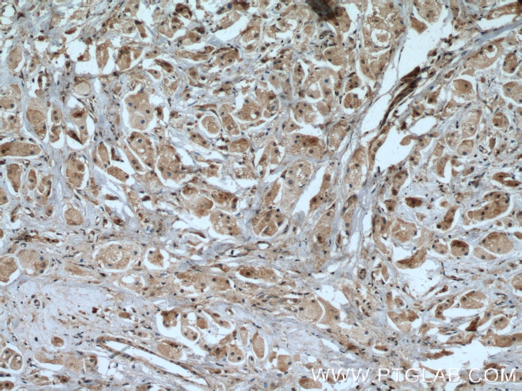 Immunohistochemistry (IHC) staining of human breast cancer tissue using IGFBP5 Polyclonal antibody (55205-1-AP)