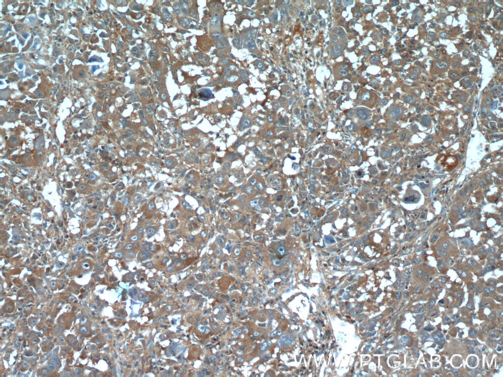 Immunohistochemistry (IHC) staining of human liver cancer tissue using IGFBP7 Polyclonal antibody (19961-1-AP)