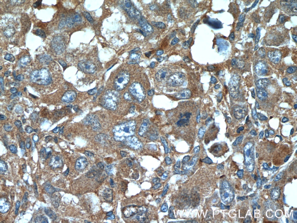 Immunohistochemistry (IHC) staining of human liver cancer tissue using IGFBP7 Polyclonal antibody (19961-1-AP)