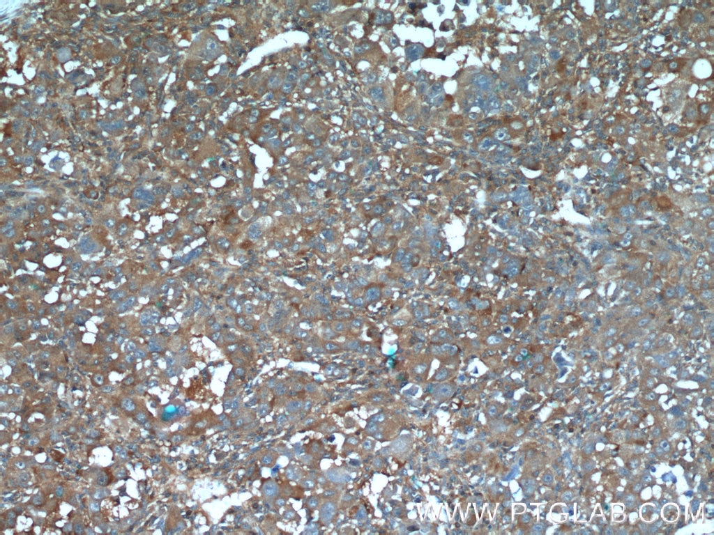 Immunohistochemistry (IHC) staining of human liver cancer tissue using IGFBP7 Polyclonal antibody (19961-1-AP)