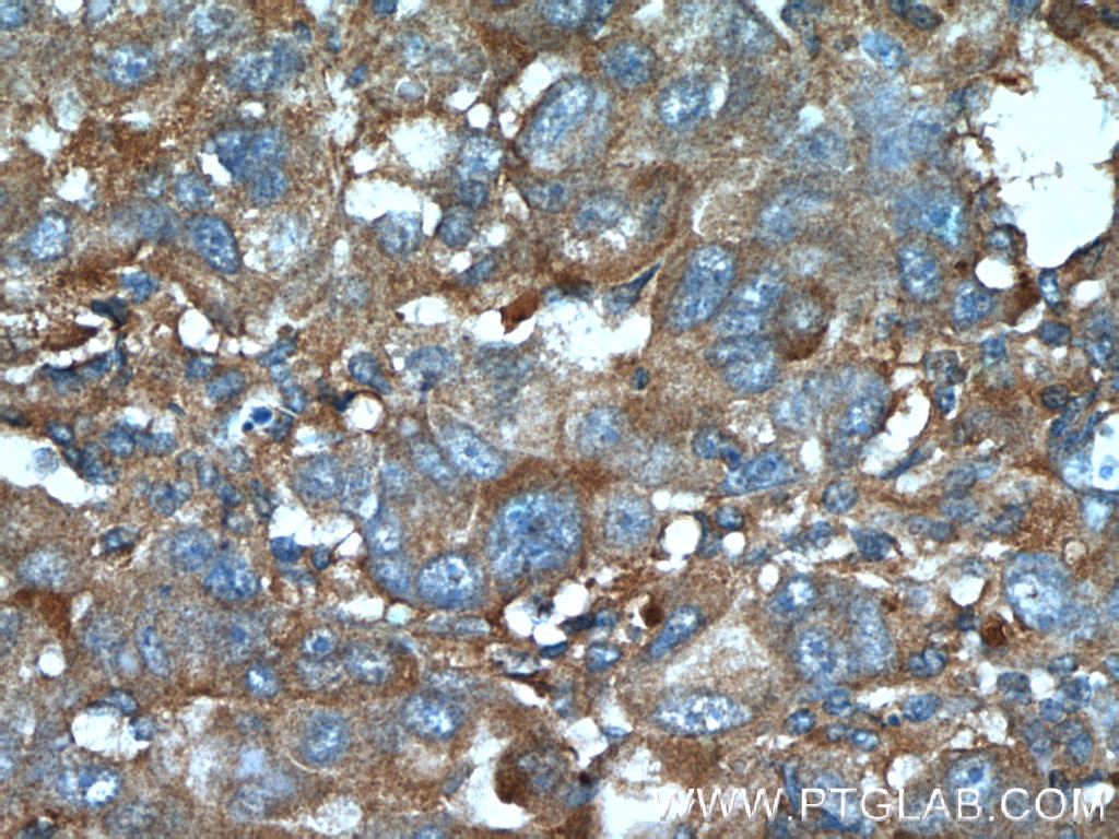 Immunohistochemistry (IHC) staining of human liver cancer tissue using IGFBP7 Polyclonal antibody (19961-1-AP)