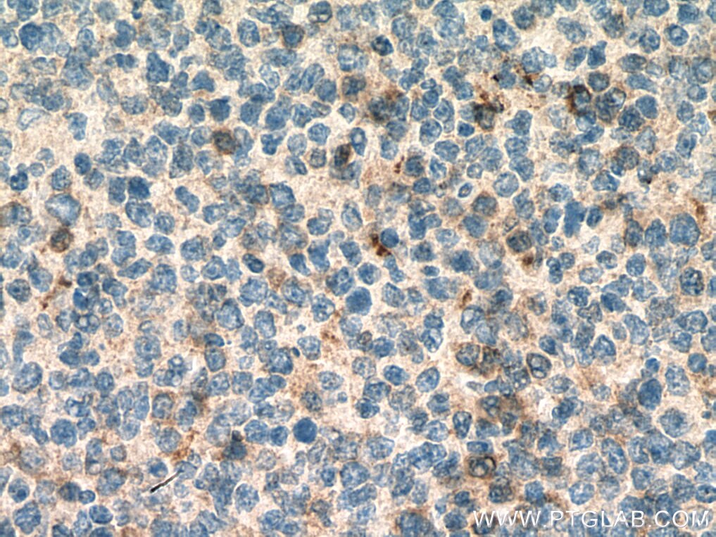 Immunohistochemistry (IHC) staining of human tonsillitis tissue using IGFL1 Polyclonal antibody (20545-1-AP)