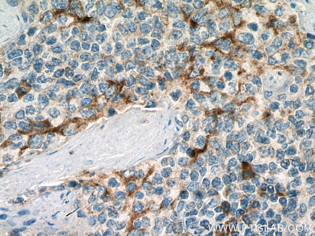 Immunohistochemistry (IHC) staining of human tonsillitis tissue using IGFL1 Polyclonal antibody (20545-1-AP)