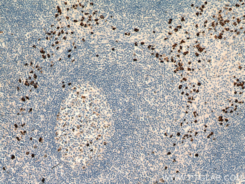 Immunohistochemistry (IHC) staining of human tonsillitis tissue using Human IgA Heavy Chain Polyclonal antibody (11449-1-AP)