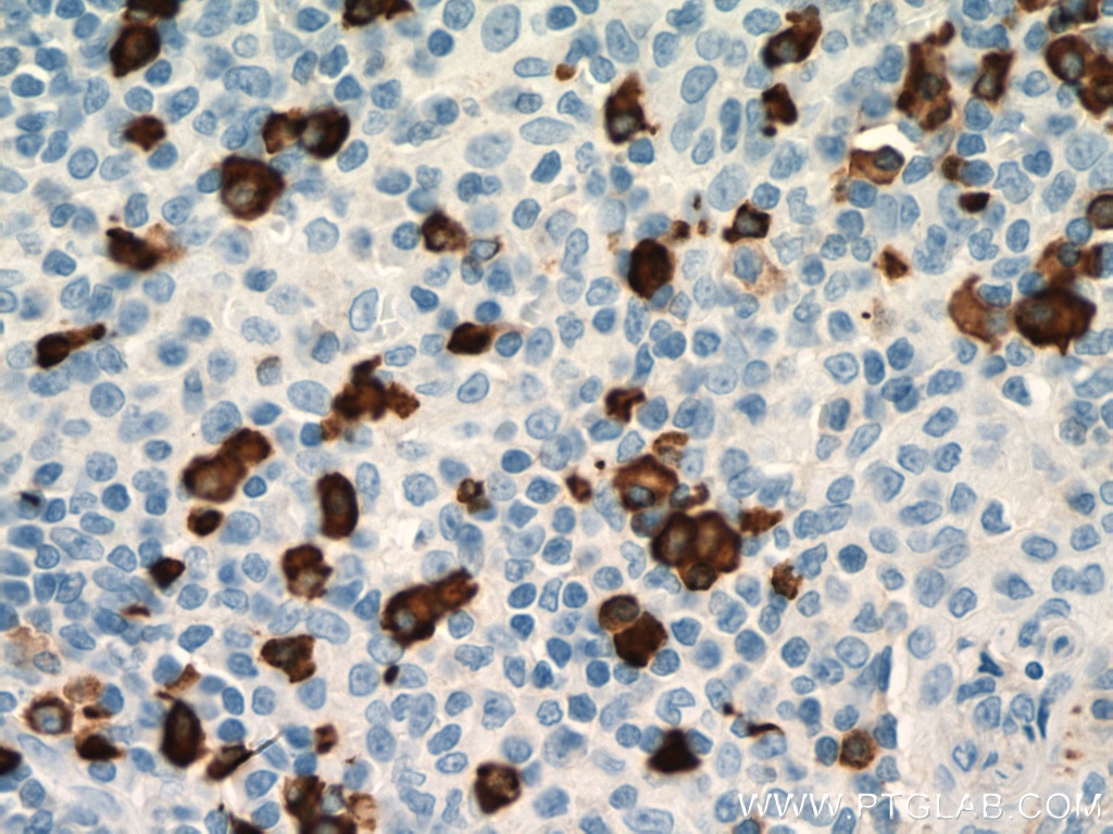 Immunohistochemistry (IHC) staining of human tonsillitis tissue using Human IgA Heavy Chain Polyclonal antibody (11449-1-AP)