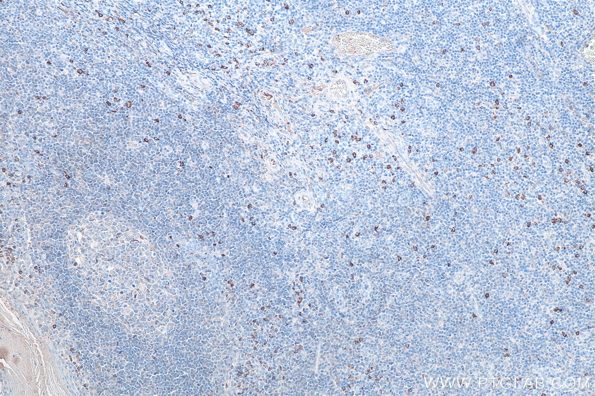 IHC staining of human tonsillitis using 60099-1-Ig Immunohistochemistry (IHC) staining of human tonsillitis tissue using Human IgA Monoclonal antibody (60099-1-Ig)