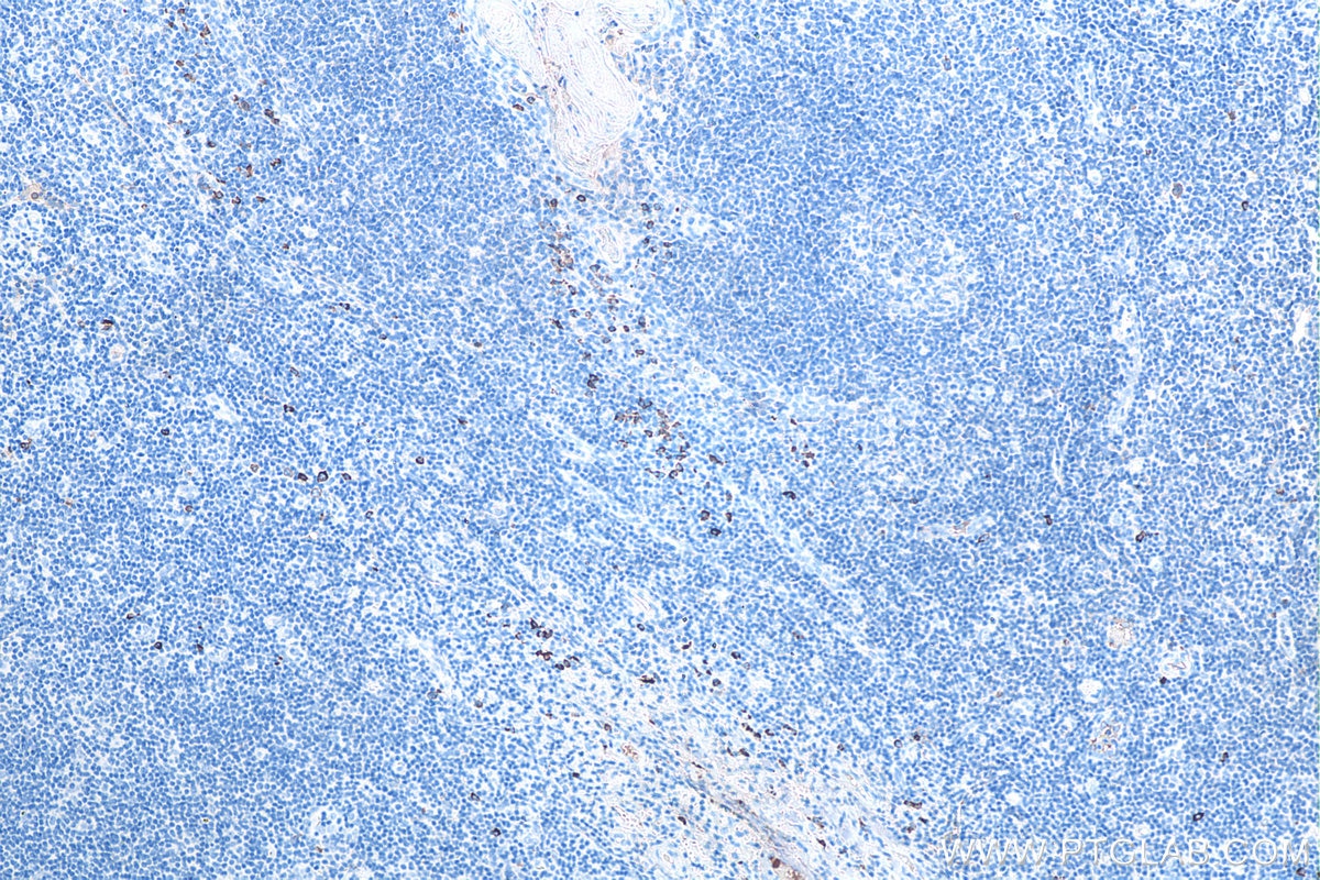 Immunohistochemistry (IHC) staining of human tonsillitis tissue using Human IgA Monoclonal antibody (60099-1-Ig)