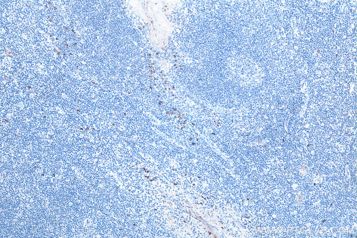 IHC staining of human tonsillitis using 60099-1-Ig