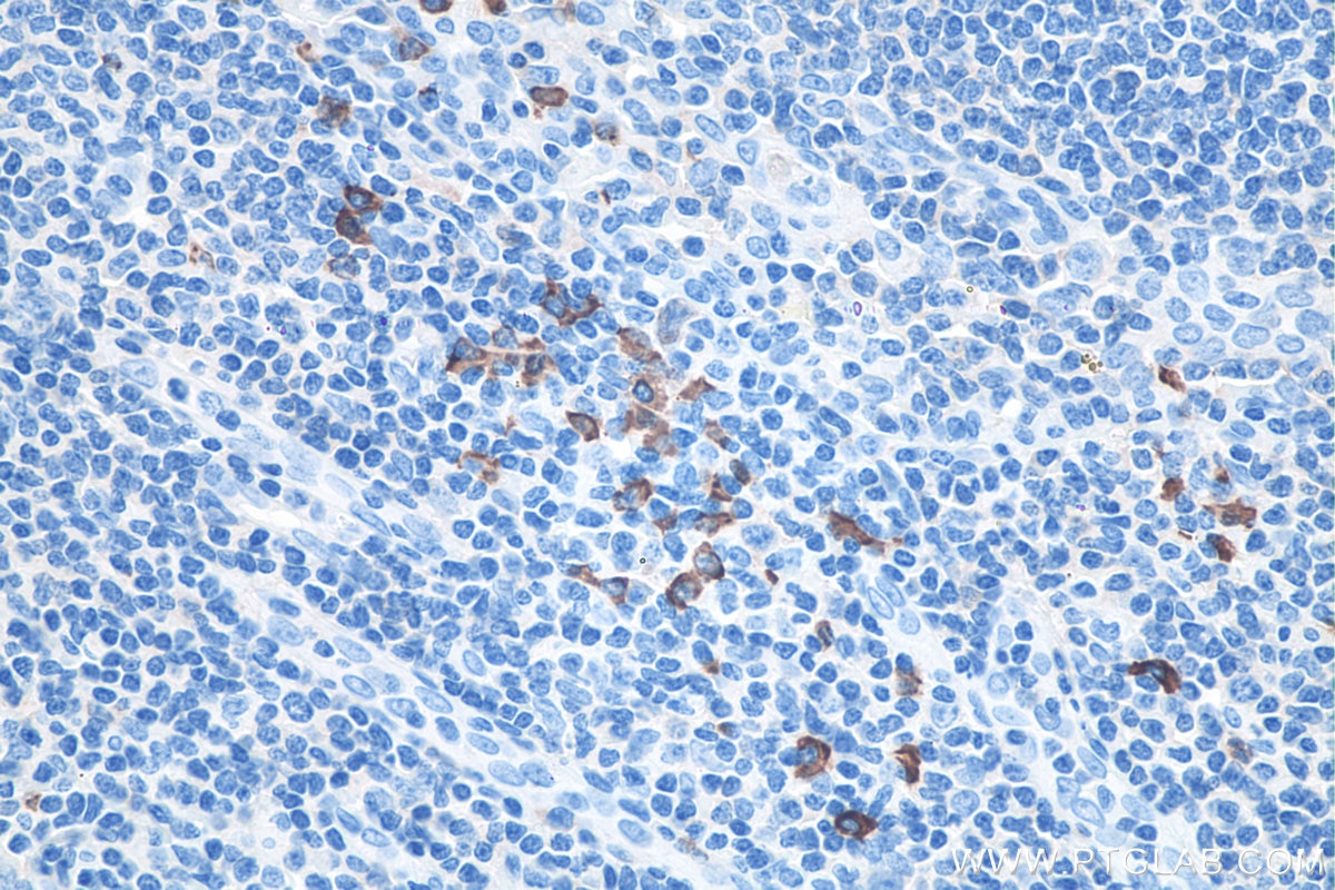 IHC staining of human tonsillitis using 60099-1-Ig