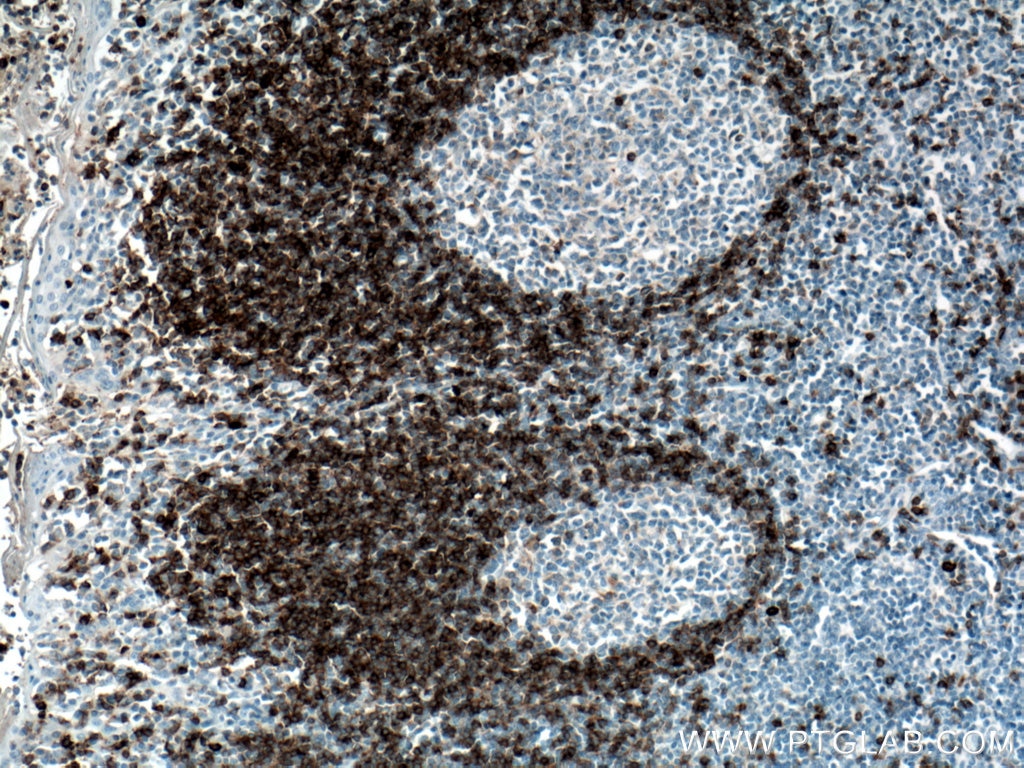 Immunohistochemistry (IHC) staining of human tonsillitis tissue using human IgD Polyclonal antibody (16489-1-AP)