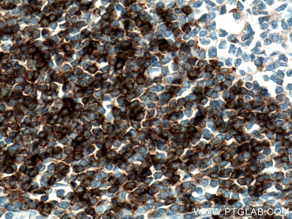 Immunohistochemistry (IHC) staining of human tonsillitis tissue using human IgD Polyclonal antibody (16489-1-AP)