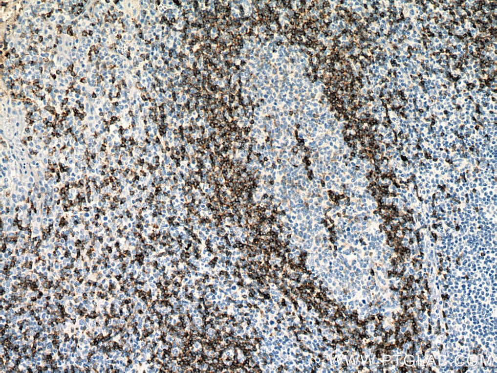 Immunohistochemistry (IHC) staining of human tonsillitis tissue using human IgD Monoclonal antibody (67538-1-Ig)