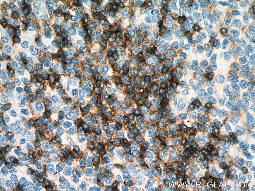 Immunohistochemistry (IHC) staining of human tonsillitis tissue using human IgD Monoclonal antibody (67538-1-Ig)