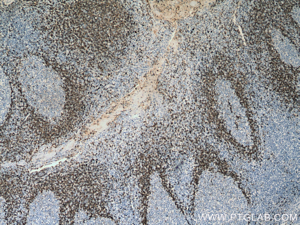 IHC staining of human tonsillitis using 67538-1-Ig