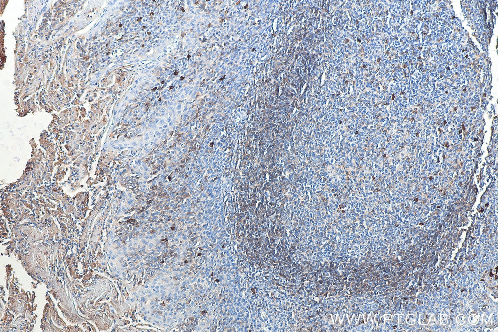 Immunohistochemistry (IHC) staining of human tonsillitis tissue using Biotin-conjugated human IgD Monoclonal antibody (Biotin-67538)