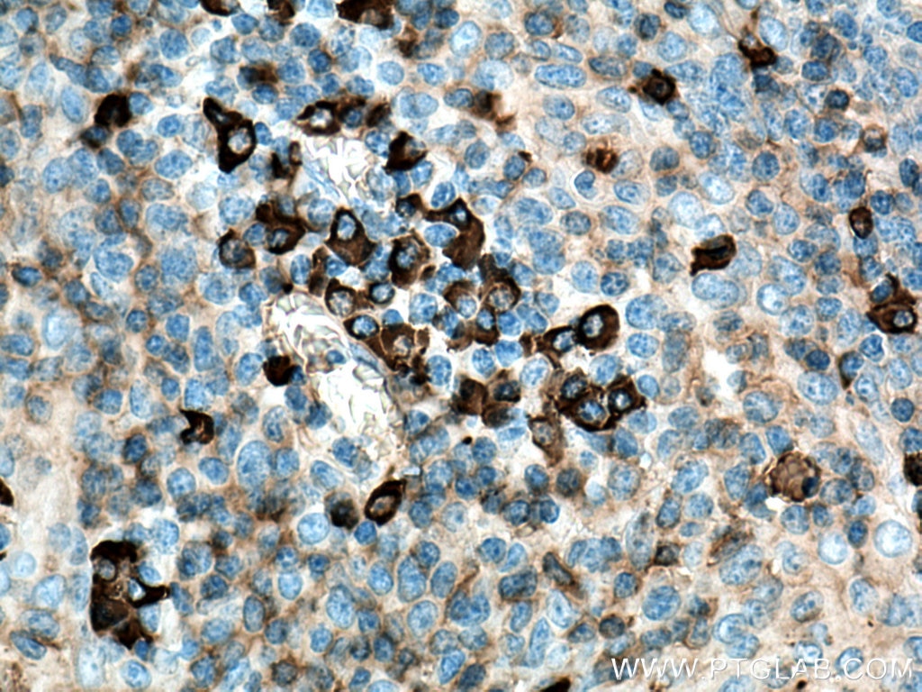 IHC staining of human tonsillitis using 16402-1-AP