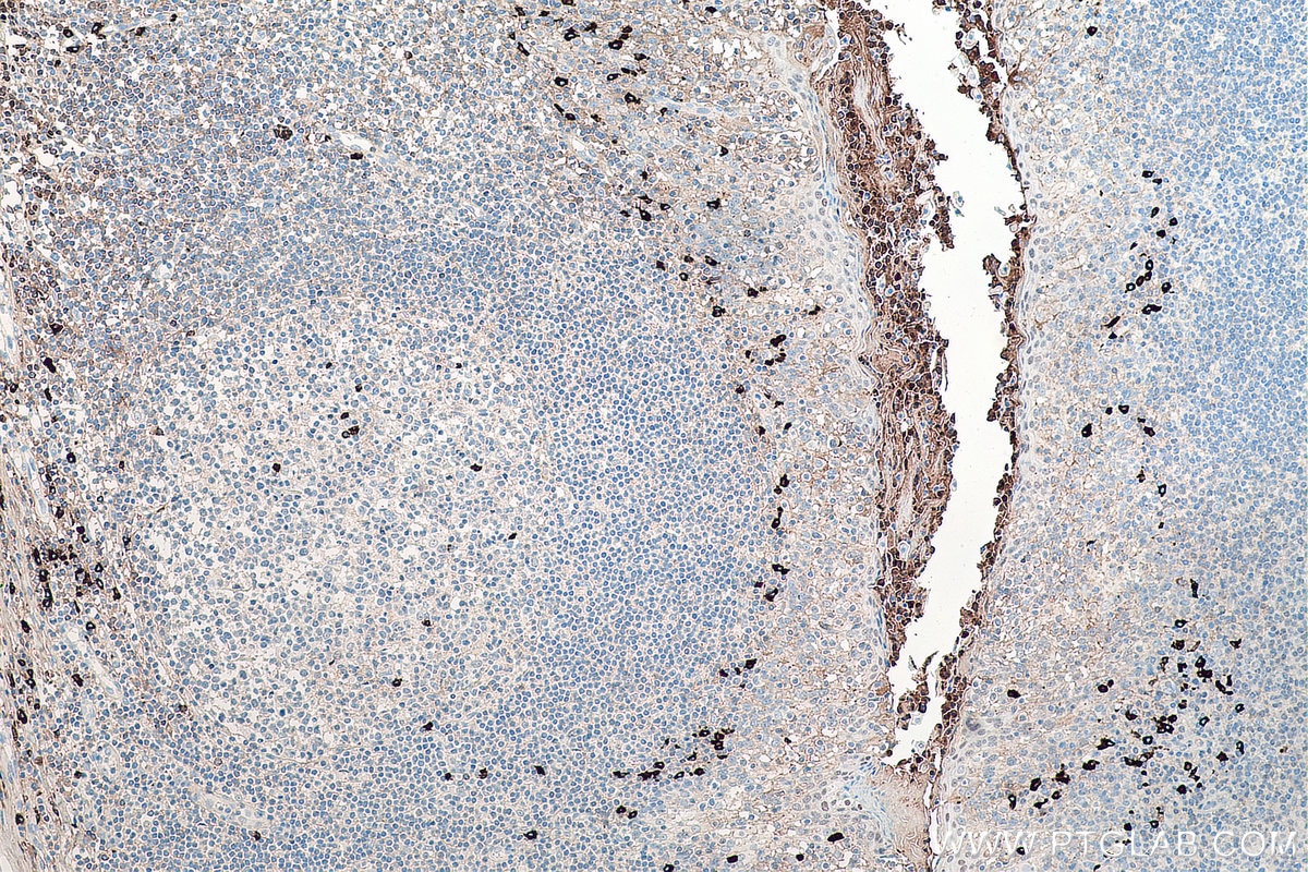 IHC staining of human tonsillitis using 66408-1-Ig