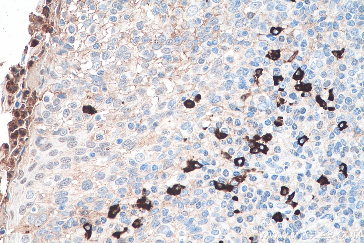 Immunohistochemistry (IHC) staining of human tonsillitis tissue using Human IgG4 Monoclonal antibody (66408-1-Ig)