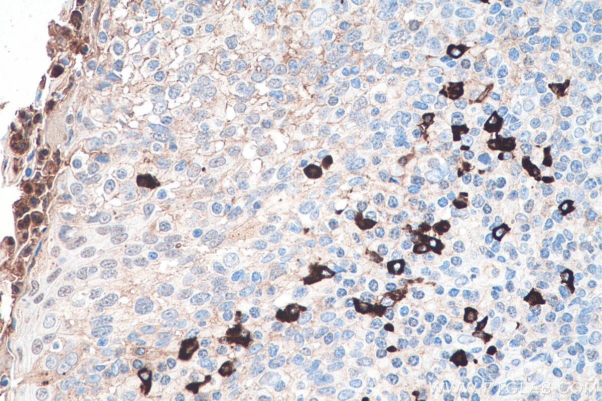 IHC staining of human tonsillitis using 66408-1-Ig