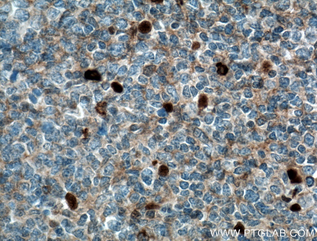 Immunohistochemistry (IHC) staining of human tonsillitis tissue using human IgM Polyclonal antibody (11016-1-AP)