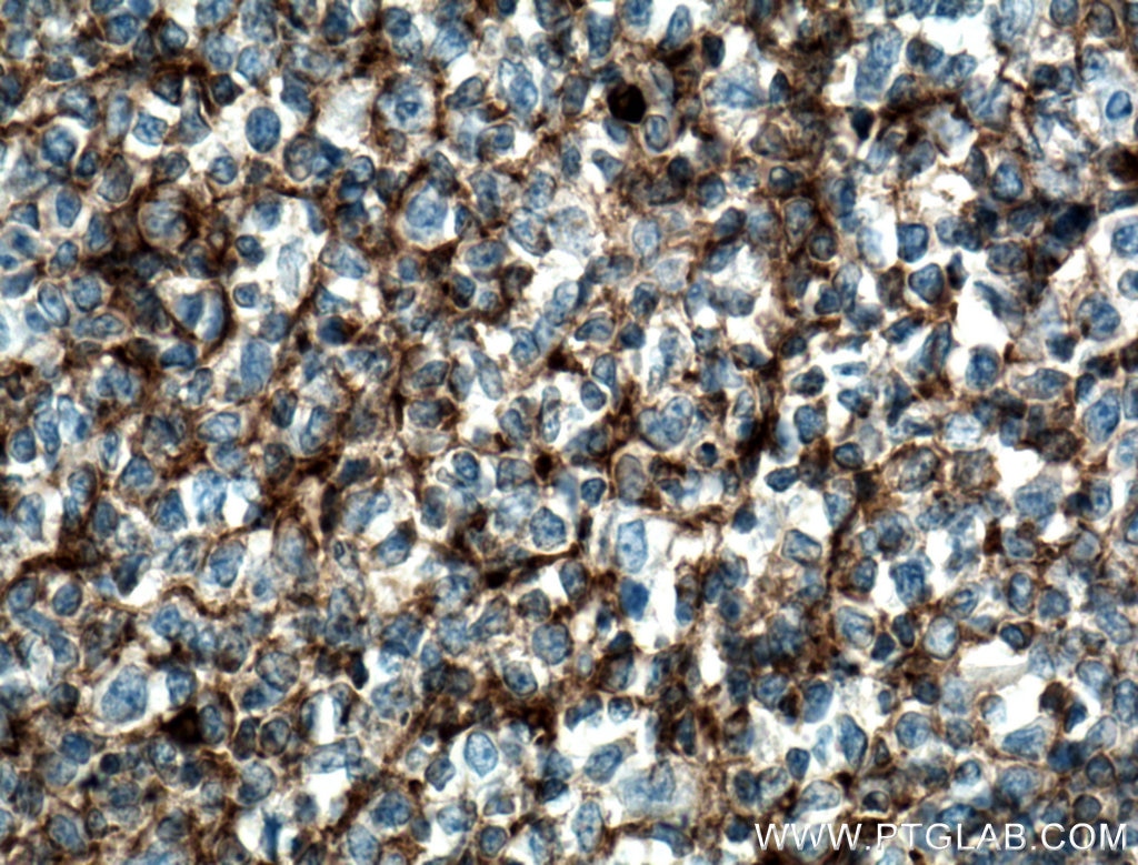 IHC staining of human tonsillitis using 66484-1-Ig