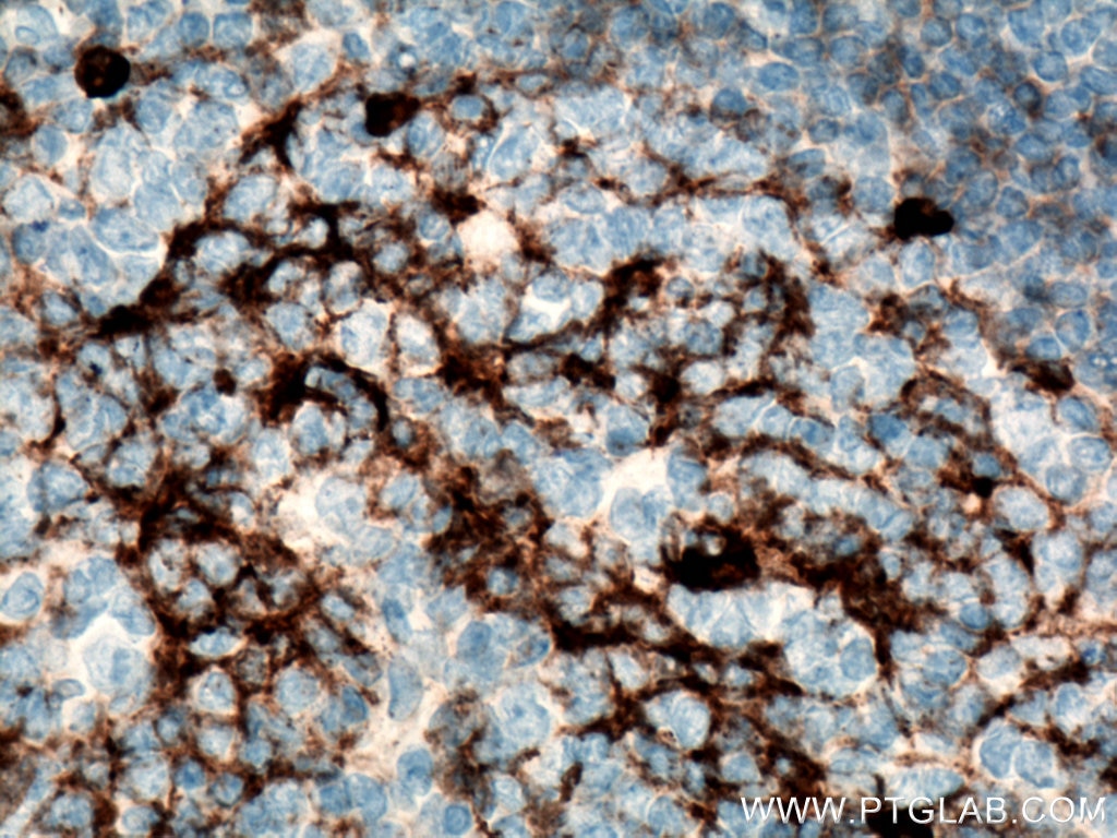 IHC staining of human tonsillitis using 66484-1-Ig