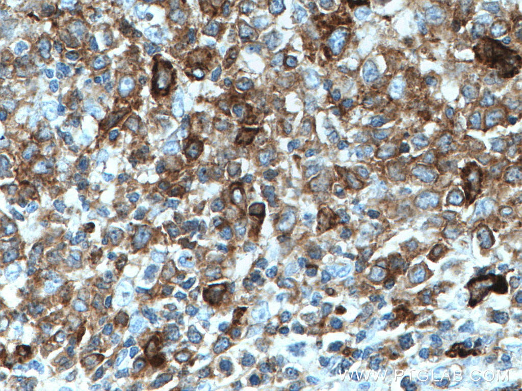 Immunohistochemistry (IHC) staining of human lymphoma tissue using human IgM Monoclonal antibody (66484-1-Ig)