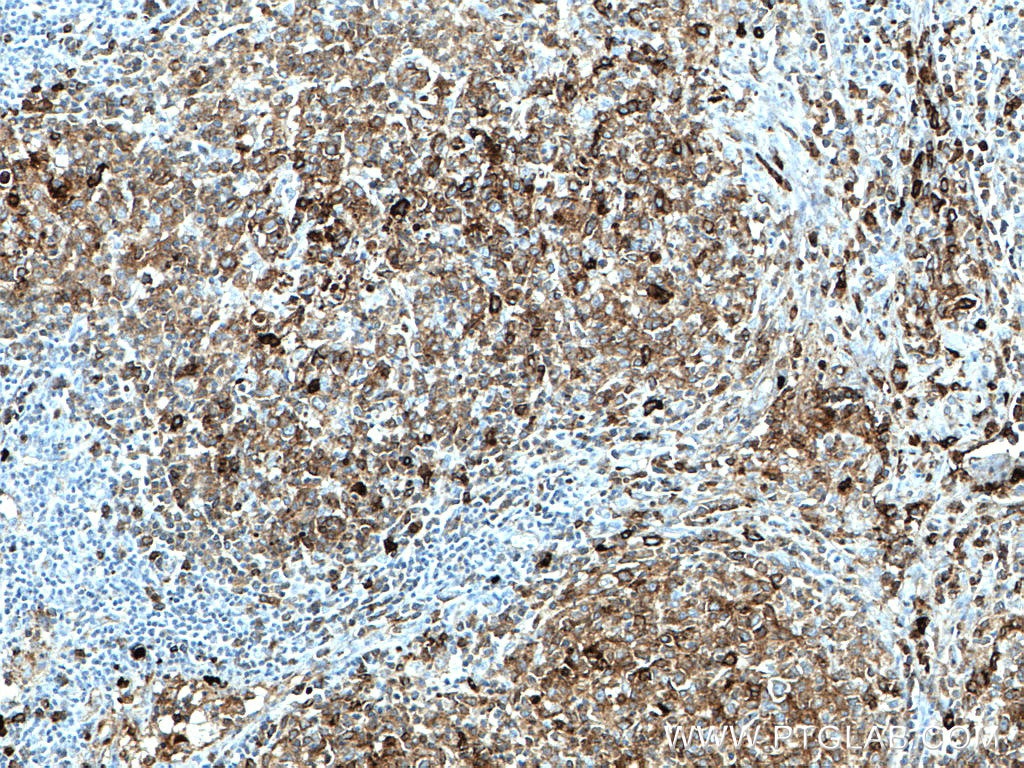 Immunohistochemistry (IHC) staining of human lymphoma tissue using human IgM Monoclonal antibody (66484-1-Ig)